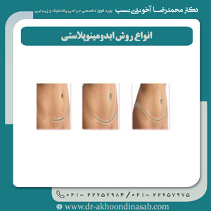 انواع روش ابدومینوپلاستی