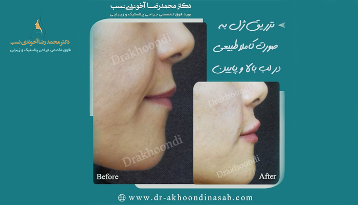 نمونه کار جوانسازی صورت بدون جراحی