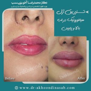 تزریق ژل لب بالا و پایین