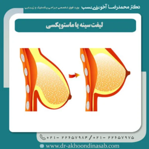 لیفت سینه یا ماستوپکسی