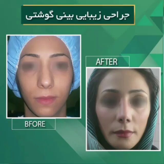 تکنیک های مدرن رینوپلاستی