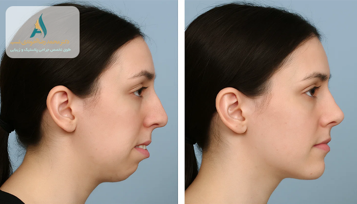 عکس قبل و بعد جراحی فک