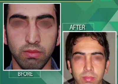 جراحی زیبایی بینی به صورت طبیعی و جراحی انحراف تیغه بینی_000