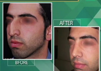 جراحی زیبایی بینی به صورت طبیعی و جراحی انحراف تیغه بینی_053