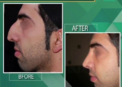 جراحی زیبایی بینی به صورت طبیعی و جراحی انحراف تیغه بینی_096