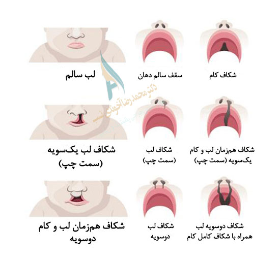 انواع-شکاف-لب