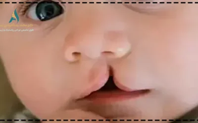 شکاف لب و کام؛ هرآنچه باید بدانید