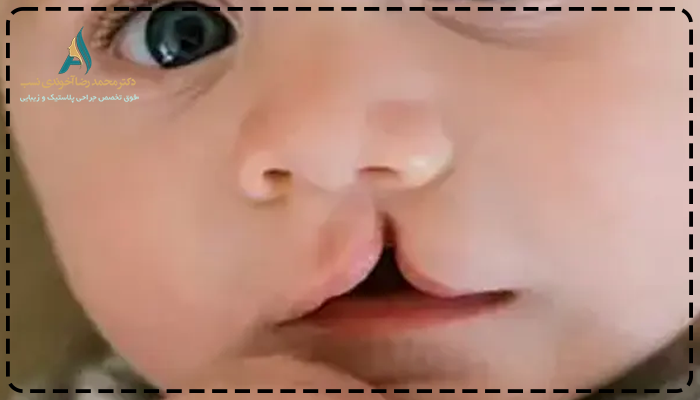 لب شکری