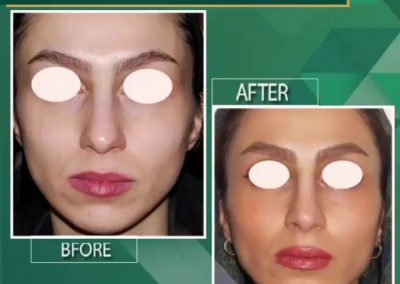 جراحی بینی و پروتز چانه
