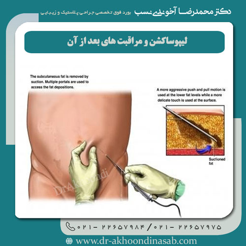 لیپوساکشن-و-مراقبتهای-بعد-از-آن