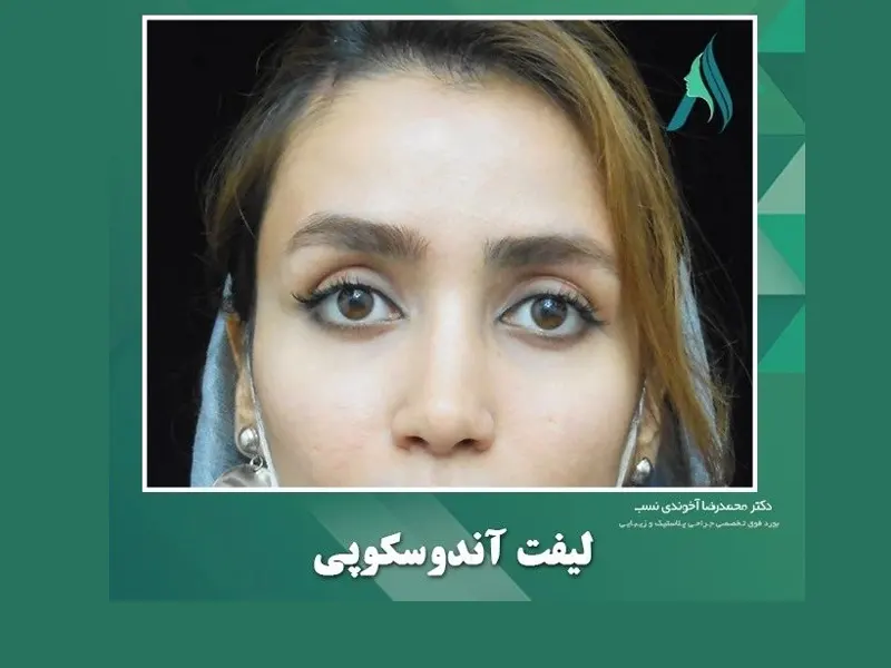 لیفت ابرو و پیشانی