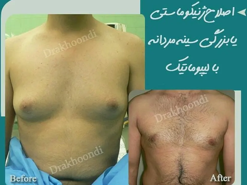 ژنیکوماستی