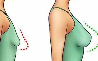 پروتز سینه؛ راز سینه‌های خوش فرم
